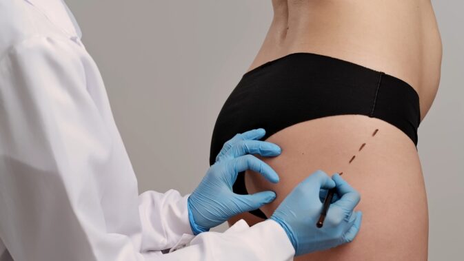 The,Surgeon,Marks,The,Skin,On,The,Patient's,Buttocks,And